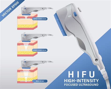 HIFU SKIN TIGHTENING – ULTRAFORMER III.